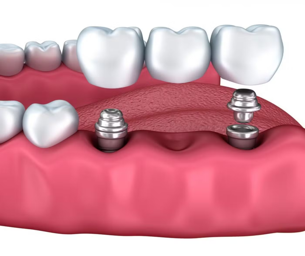 Multiple Teeth Implants- Dr Arman Barfeie Prosthodontist Official Website