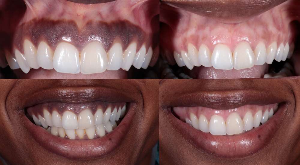 Before and after image of gum bleaching, showing significant improvement in gum color