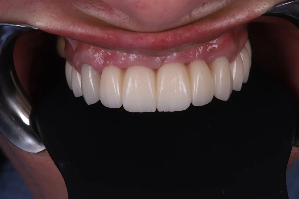 Close-up view of upper dental implants