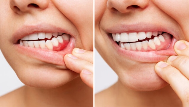 Comparison of unhealthy gums with redness and swelling versus healthy pink gums
