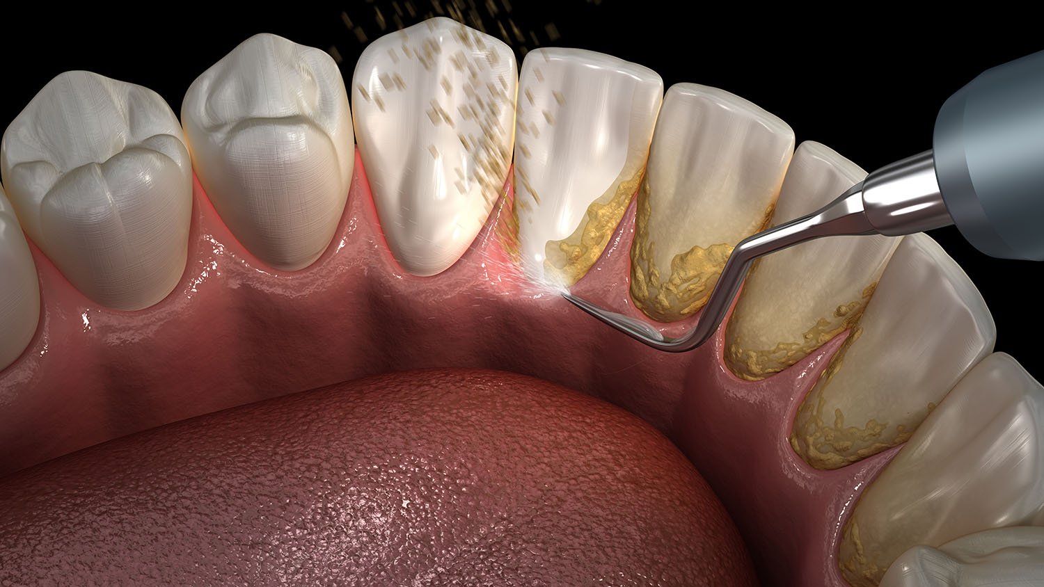 Dental scaling procedure removing hardened tartar and plaque from teeth near the gumline