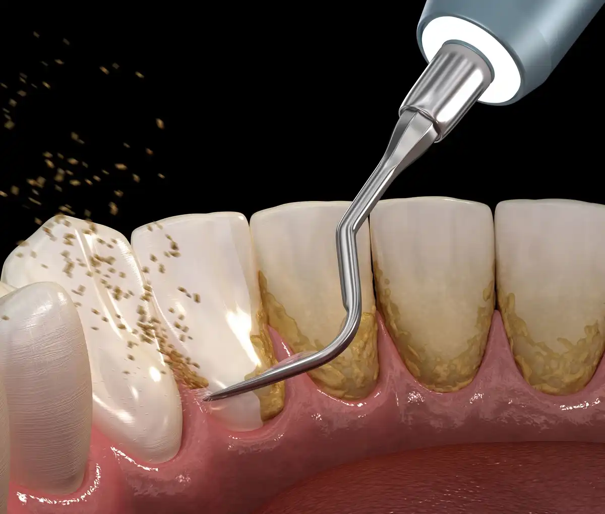Dental scaling procedure removing tartar from teeth and improving gum health