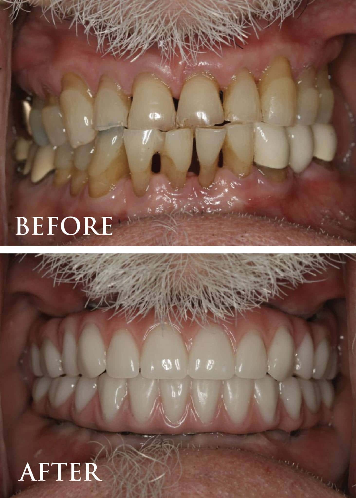 Before and after periodontic treatment showing restored gum health