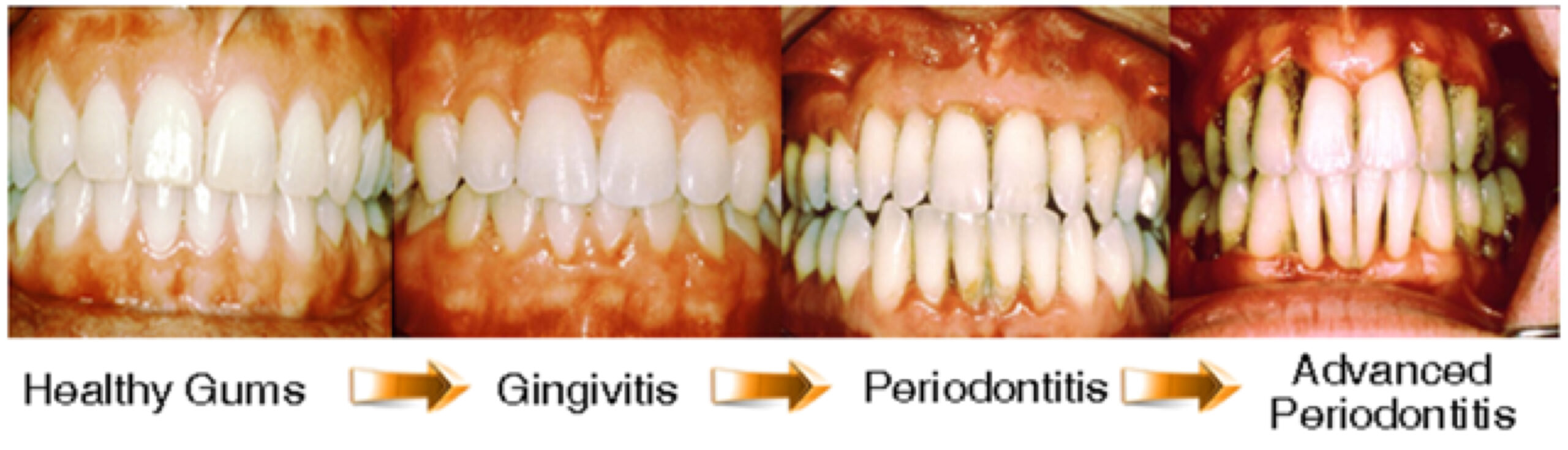 Stages of gum disease progression from healthy gums to gingivitis, periodontitis, and advanced periodontitis
