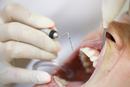 Dentist using a periodontal probe to examine gum pocket depth during a dental check-up
