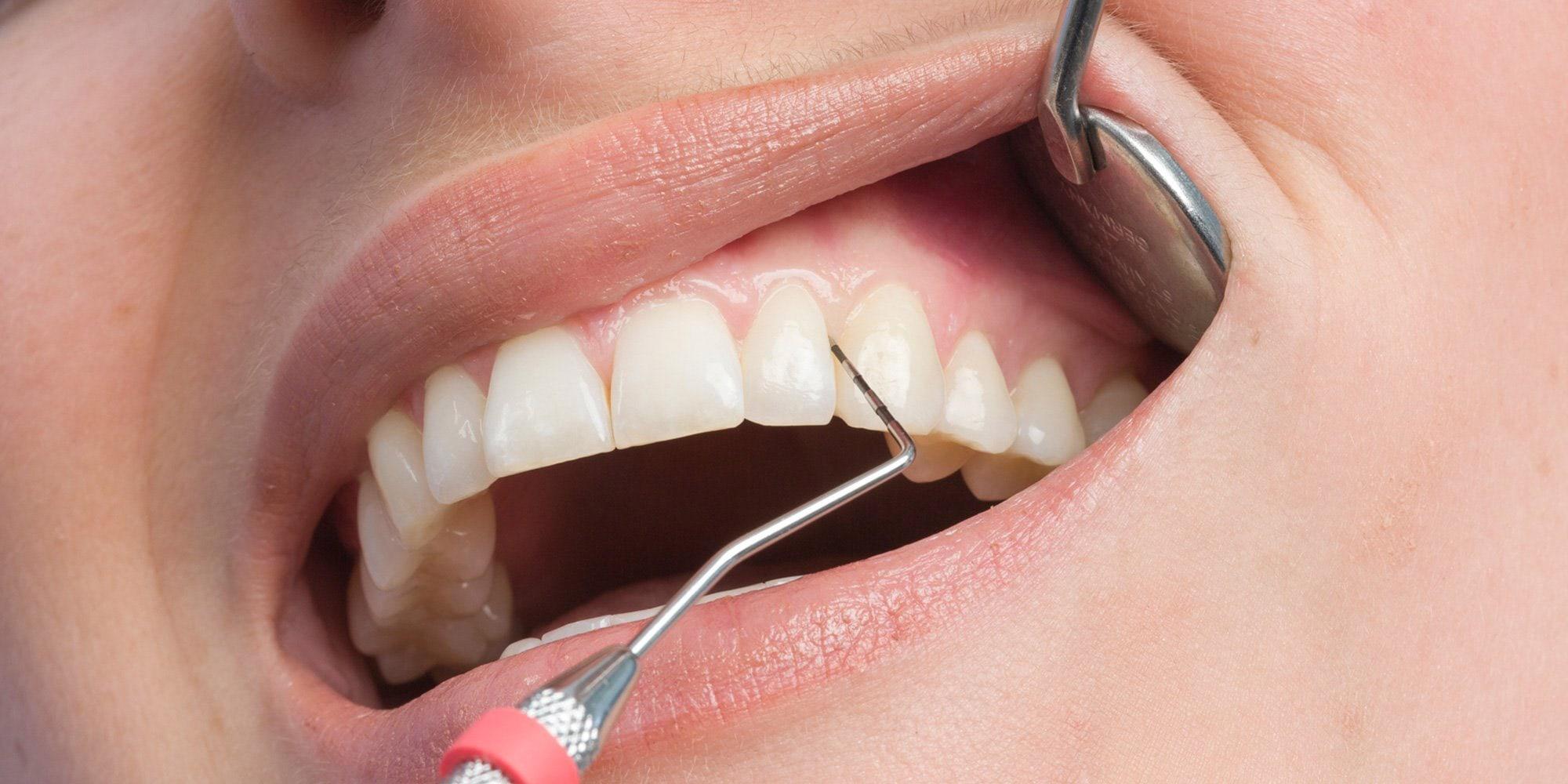 “Dentist using a periodontal probe to check gum health and pocket depth around teeth