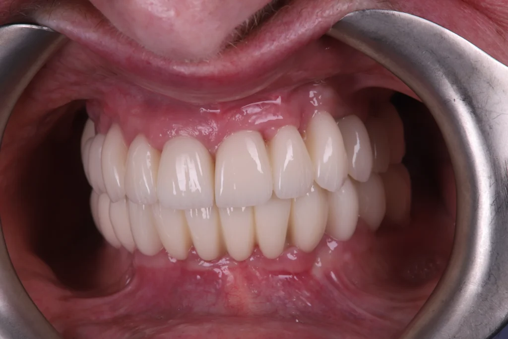 Close-up of dental implants with full set of artificial teeth