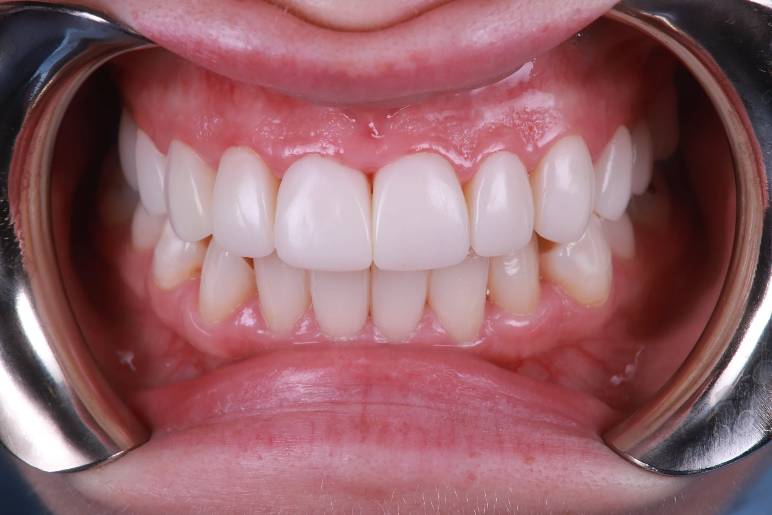 Close-up of well-aligned and bright teeth following composite bonding treatment