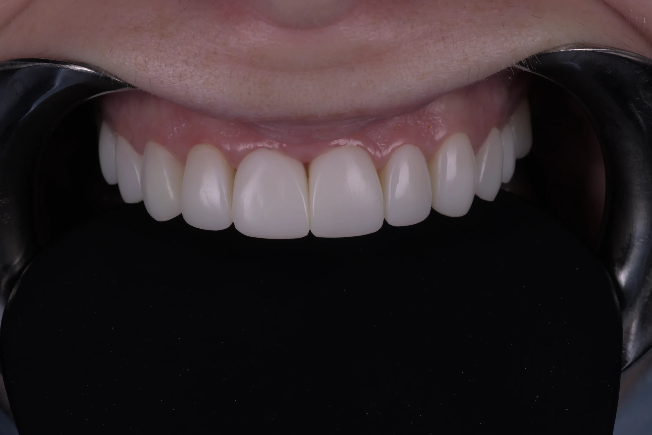 Close-up of perfect teeth after a composite bonding