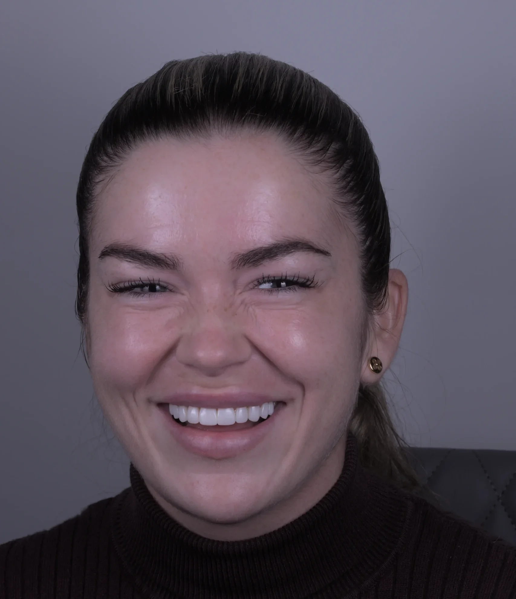Woman with white teeth following composite bonding