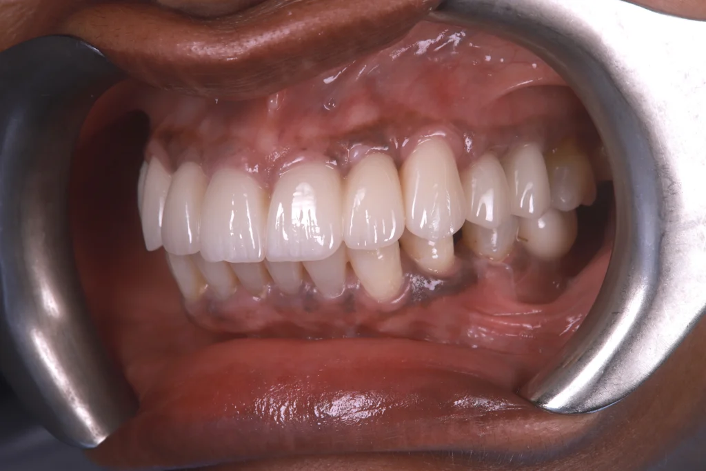 Close-up of dental implant-supported teeth