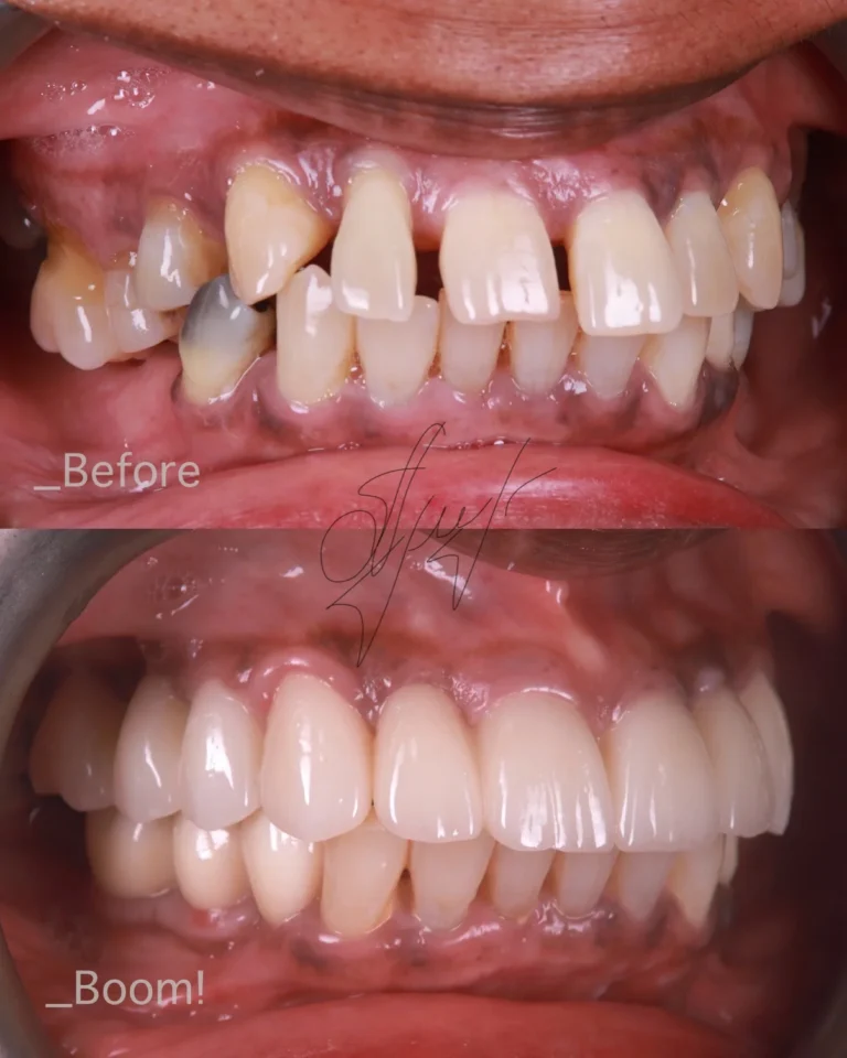 before and after dental implants
