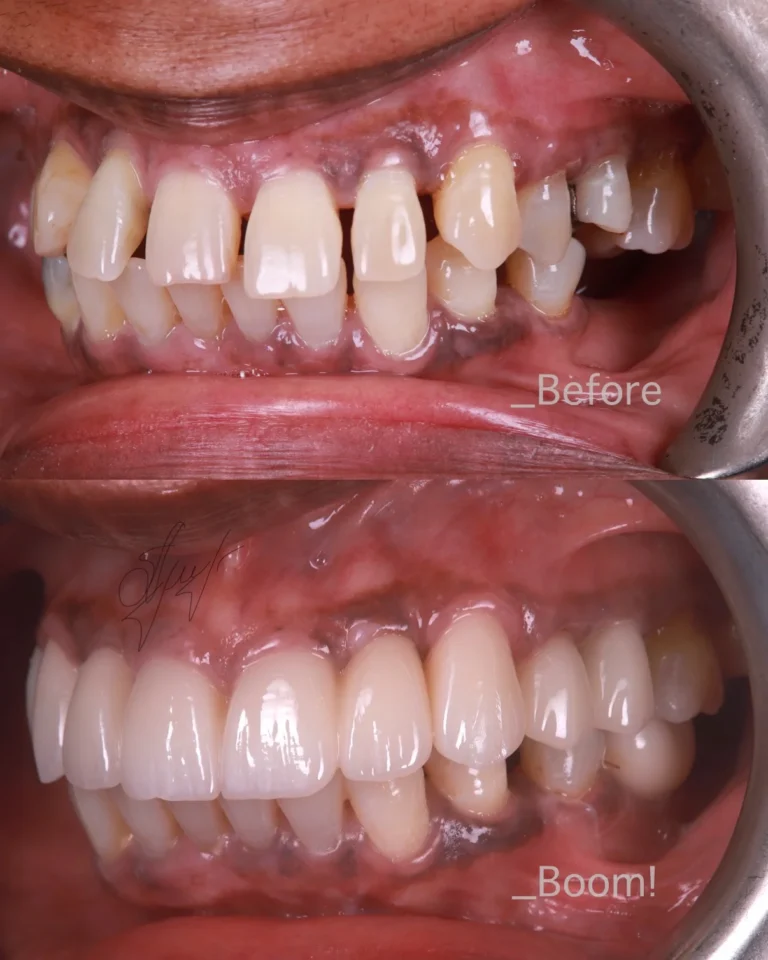 before and after dental implants in forest hill