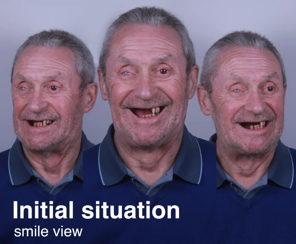 Before treatment with a single dental implant: showing smile view with missing teeth