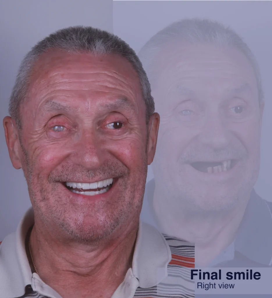 Dental Implants in Forest Hill, London- Dr Arman Barfeie Prosthodontist Official Website