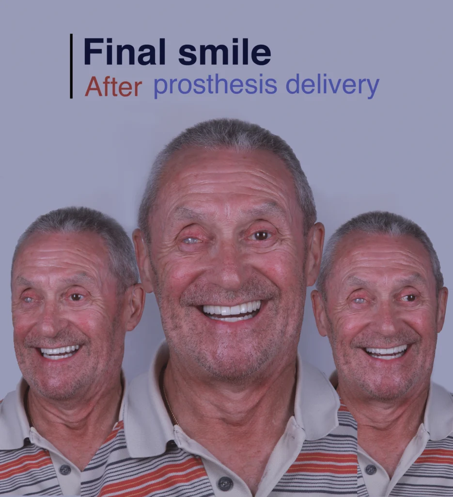 After treatment with a single dental implant