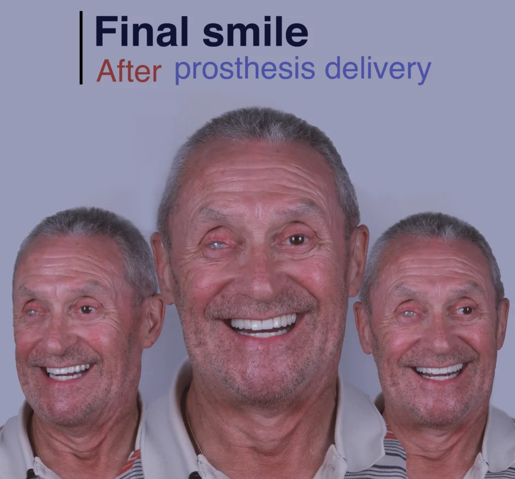 final result dental implants in london
