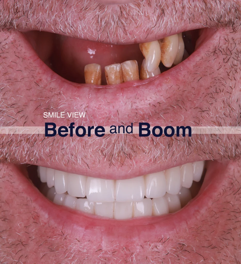 Before and after dental implant smile transformation showing missing and restored teeth