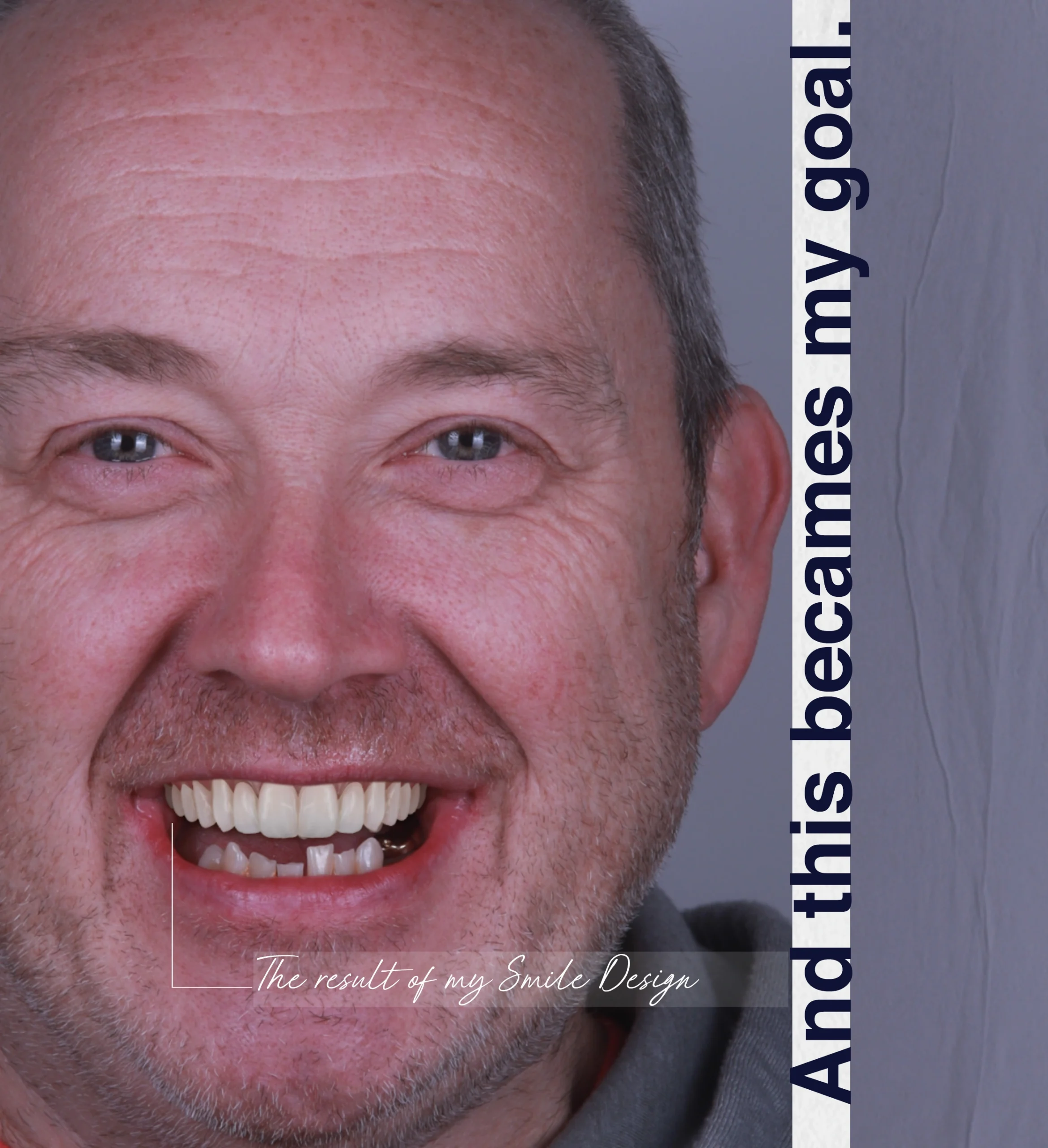 Life-changing results with a single dental implant