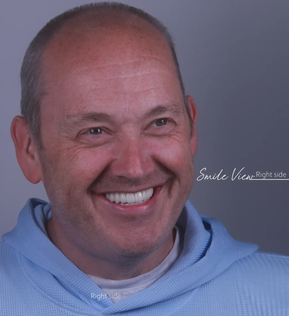 Dental Implants in Forest Hill, London- Dr Arman Barfeie Prosthodontist Official Website