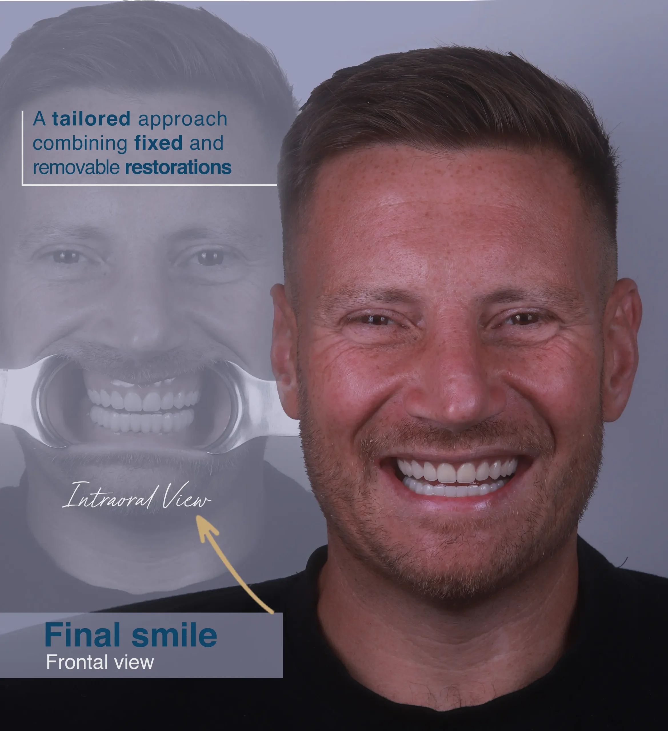 All on 4 /6 Dental Implants in forest hill, london