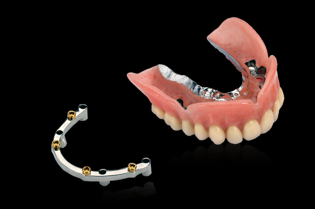 Implant Overdenture- Dr Arman Barfeie Prosthodontist Official Website