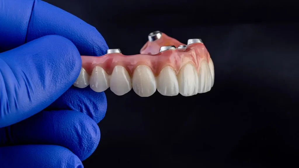 Implant Overdenture- Dr Arman Barfeie Prosthodontist Official Website