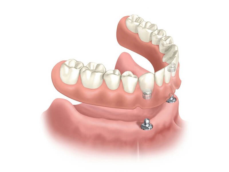 Implant Overdenture- Dr Arman Barfeie Prosthodontist Official Website