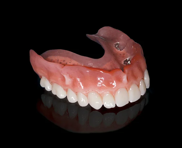Implant Overdenture- Dr Arman Barfeie Prosthodontist Official Website