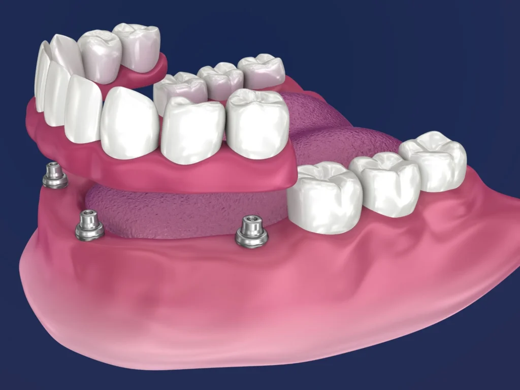 Multiple Teeth Implants- Dr Arman Barfeie Prosthodontist Official Website