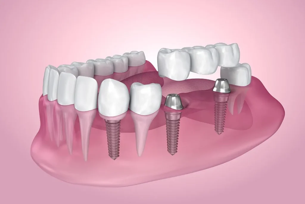 Multiple Teeth Implants- Dr Arman Barfeie Prosthodontist Official Website