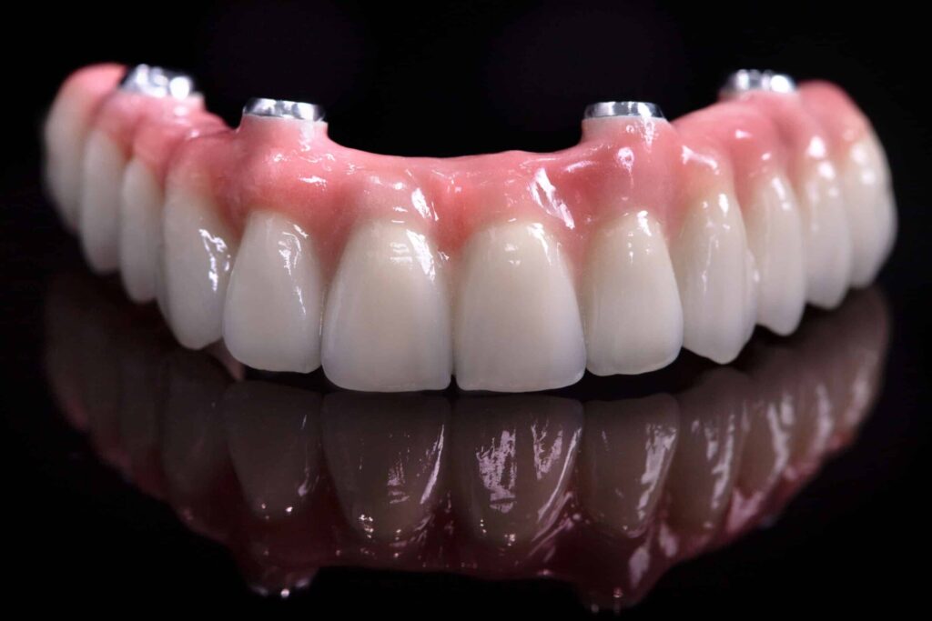 All on 4 /6 Dental Implants- Dr Arman Barfeie Prosthodontist Official Website