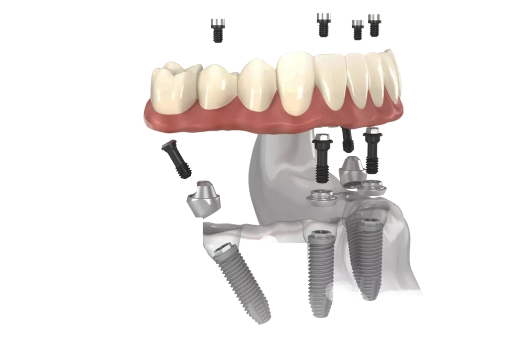3D illustration of All-on-4 dental implants