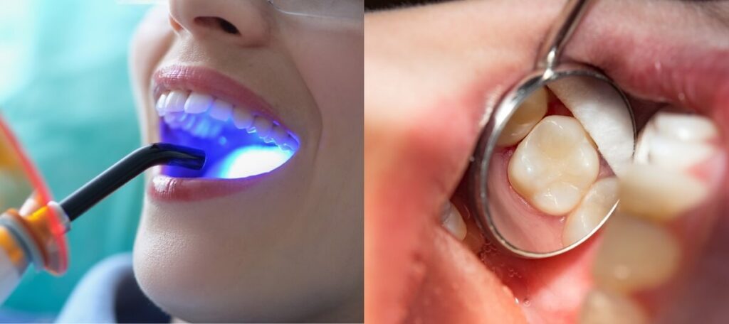 Composite Fillings- Dr Arman Barfeie Prosthodontist Official Website
