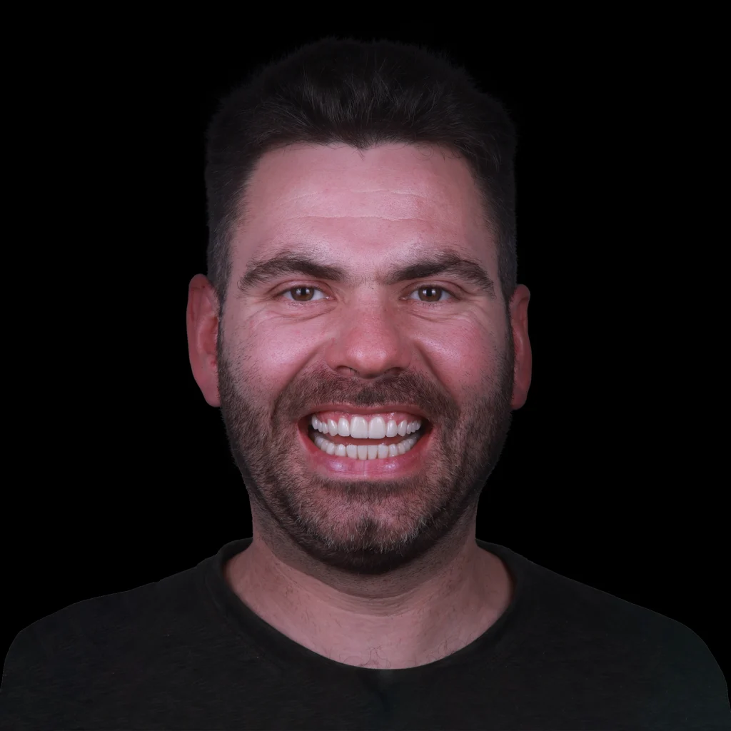 Veneers- Dr Arman Barfeie Prosthodontist Official Website