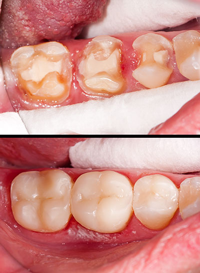 Before and after of composite fillings applied to teeth