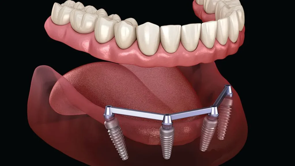 Implant Overdenture- Dr Arman Barfeie Prosthodontist Official Website