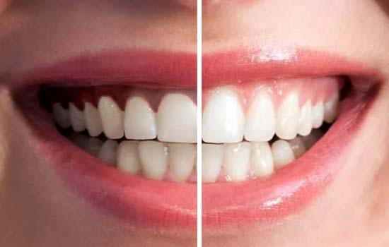 Comparison of gum appearance before and after gum bleaching
