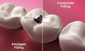 Comparison of an amalgam filling and a composite filling in a tooth