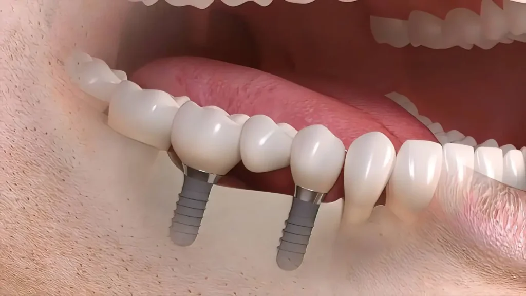 Multiple Teeth Implants- Dr Arman Barfeie Prosthodontist Official Website