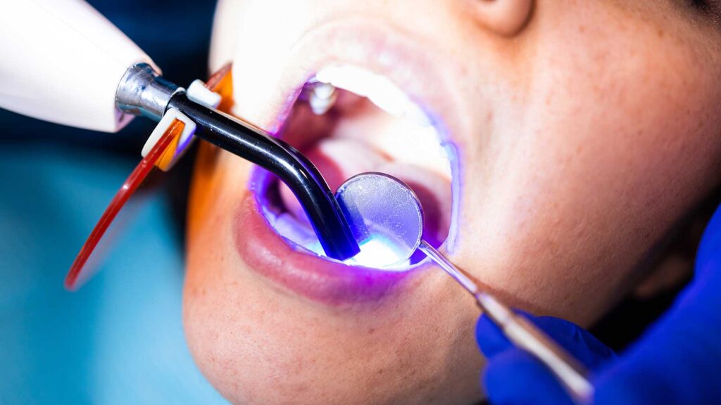 Dental professional applying UV light to cure composite filling