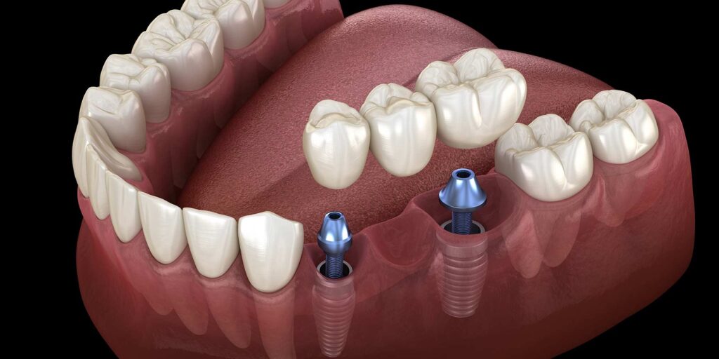 Multiple Teeth Implants- Dr Arman Barfeie Prosthodontist Official Website