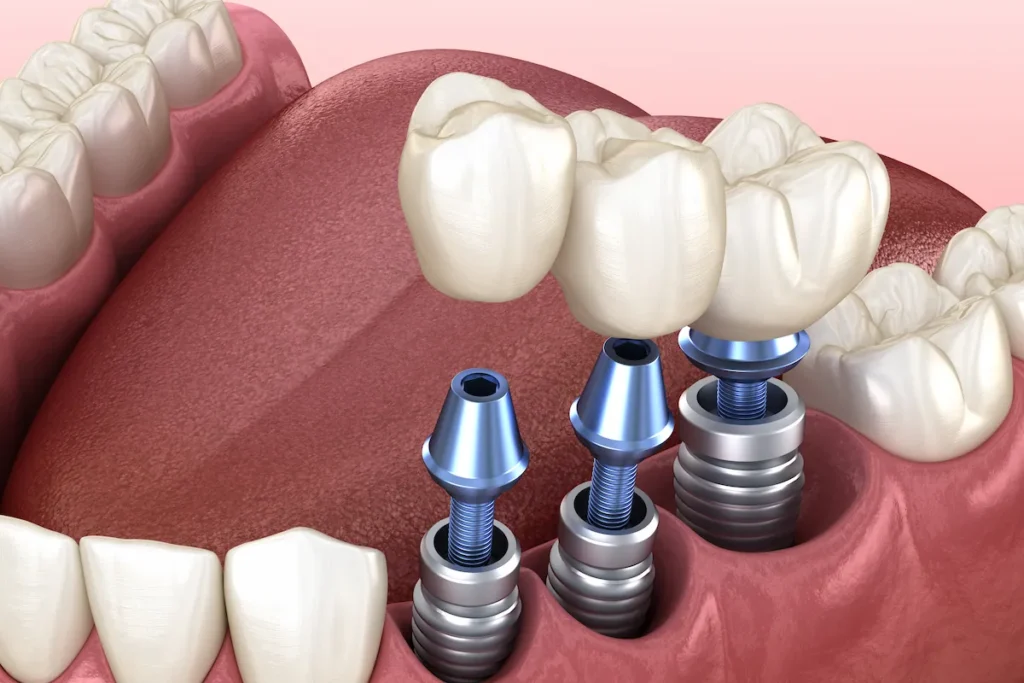 Multiple Teeth Implants- Dr Arman Barfeie Prosthodontist Official Website
