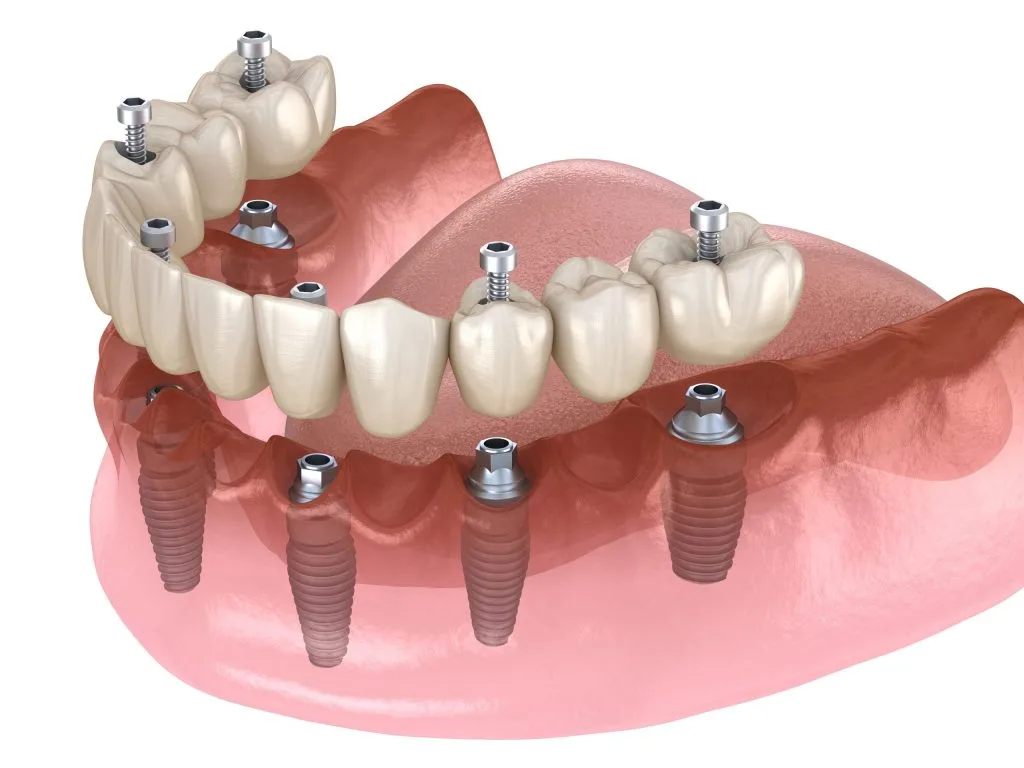 Multiple Teeth Implants- Dr Arman Barfeie Prosthodontist Official Website