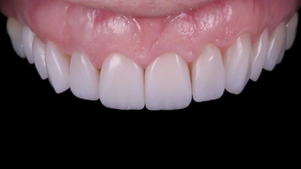 Veneers- Dr Arman Barfeie Prosthodontist Official Website