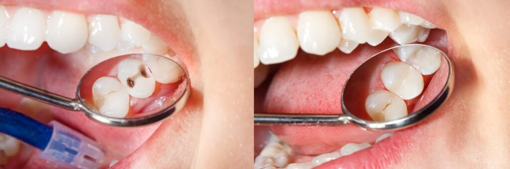 Before and after of a dental cavity being treated with a composite filling