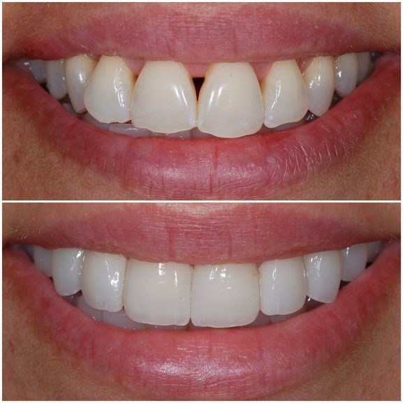 Before and after of teeth restored with crowns