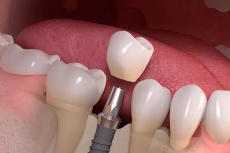 How implants solve fixed, natural-looking, and preserve bone