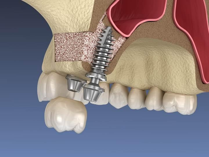 Dental Implants Aren’t for Everyone — Discover If You’re the Perfect Candidate (in 4 Steps)- Dr Arman Barfeie Prosthodontist Official Website