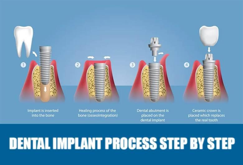 Blog 2 Blog- Dr Arman Barfeie Prosthodontist Official Website